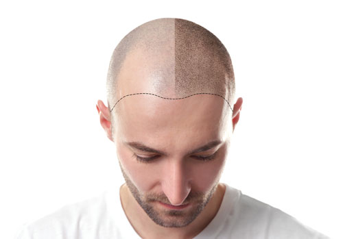 Haarptransplantation mit Eigenhaar